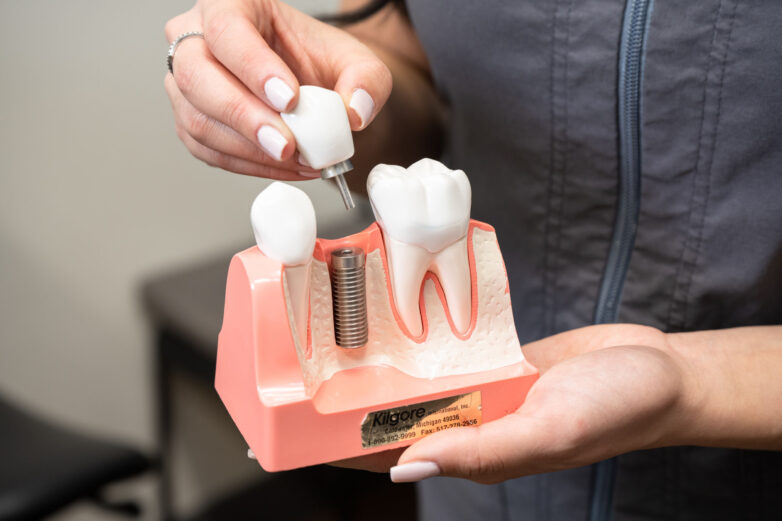 Dental implant treatment at Kensington Square Dental